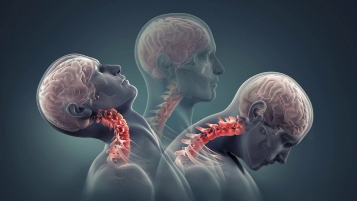 1 số dấu hiệu chỉ điểm bạn đã thoát vị đĩa đệm, thoái hóa cột sống cổ dau-hieu-cot-song-co.jpg