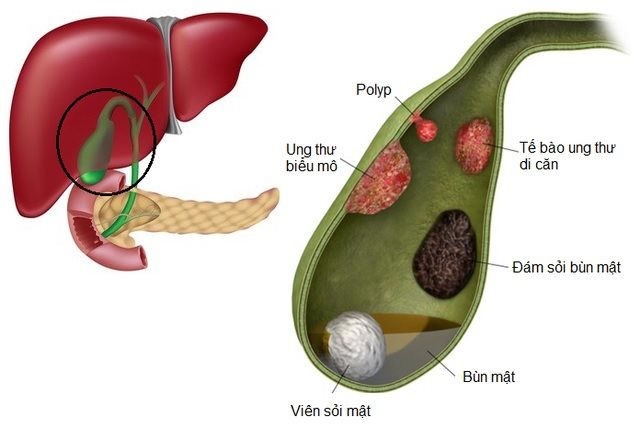 6 chữ S, dự đoán khả năng ác tính của polyp túi mật polyp-tui-mat.jpg