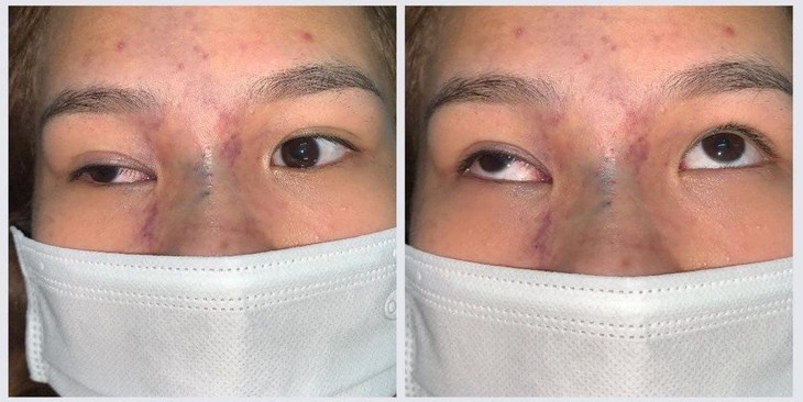 Một trường hợp bị tắc động mạch mắt sau tiêm filler tại spa. tac-dong-mach-mat-phai-1-.jpg