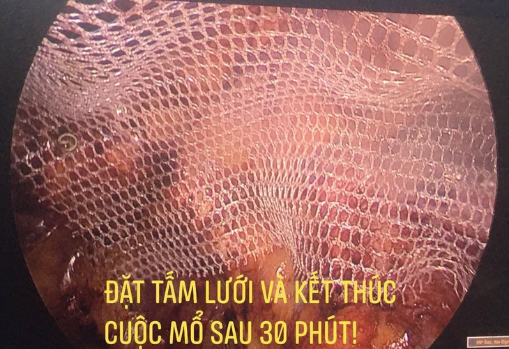 Nội soi đặt lưới điều trị thoát vị bẹn ảnh 1 thoat-vi-ben.jpg