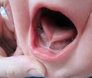 Nhiễm trùng sàn miệng nghiêm trọng do lấy gai bưởi chữa chậm nói ảnh 1 gai-buoi-thang-luoi.jpg