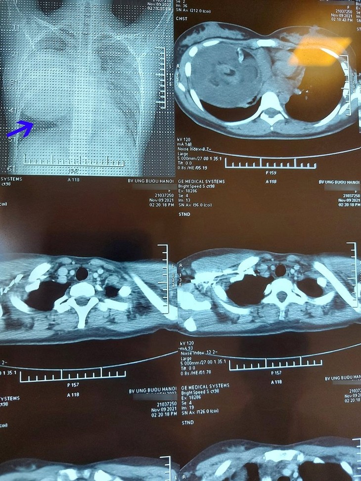 Phẫu thuật u quái chứa tóc răng xương đè xẹp phổi ảnh 1 u-quai-de-phoi.jpg
