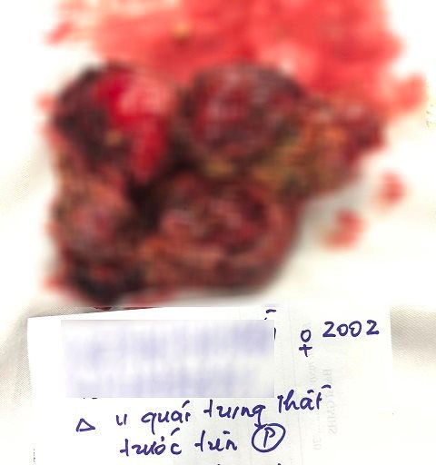 U quái sau khi được cắt bỏ u-quai.jpg