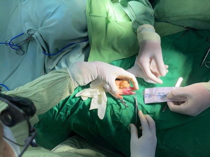 Các bác sĩ còn thực hiện ca phẫu thuật gỡ dinh các ngón tay. tach-dinh-ngon-tay.jpg