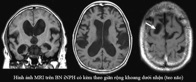 Hình ảnh tổn thương trên phim chụp gian-nao-that-1.jpg