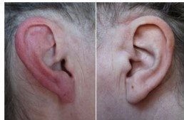 Đỏ tai và đau nửa đầu ảnh 1 do-tai-sau-gai(1).jpg
