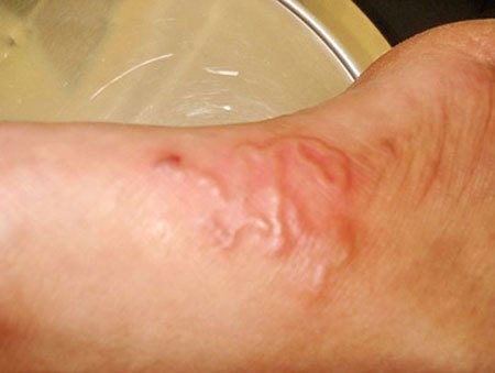 Giun lươn biểu hiện trên da. giun-luon.jpg