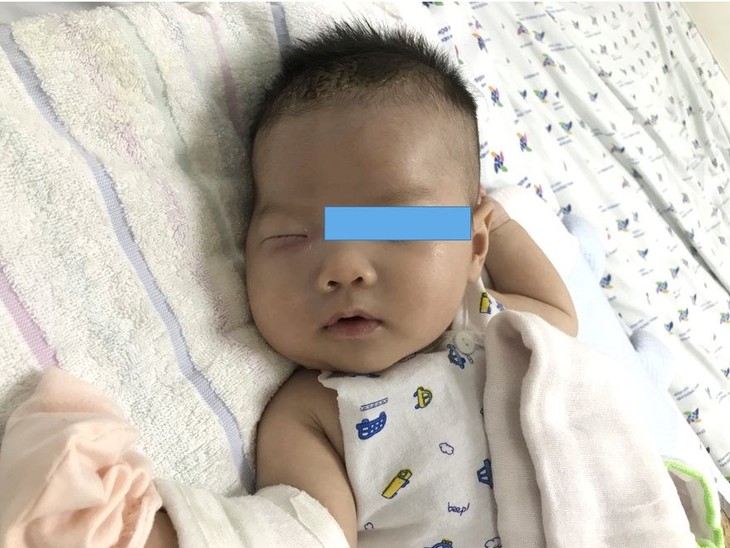 Bệnh nhi 1,5 tháng tuổi bị nhiễm trùng vùng khoang miệng dẫn tới viêm mô tế bào hóa mủ. Ảnh bệnh viện. viem-mo-te-bao-1.jpeg