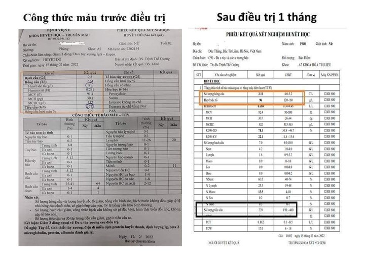 Phác đồ Lenalidomide – Dexamethasol liều thấp cứu bệnh nhân suy tủy do đa cong-thuc-mau.jpg