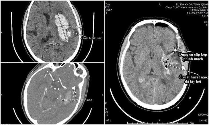 Hình ảnh phim chụp của bệnh nhân trước và sau phẫu thuật vi-phau.jpg