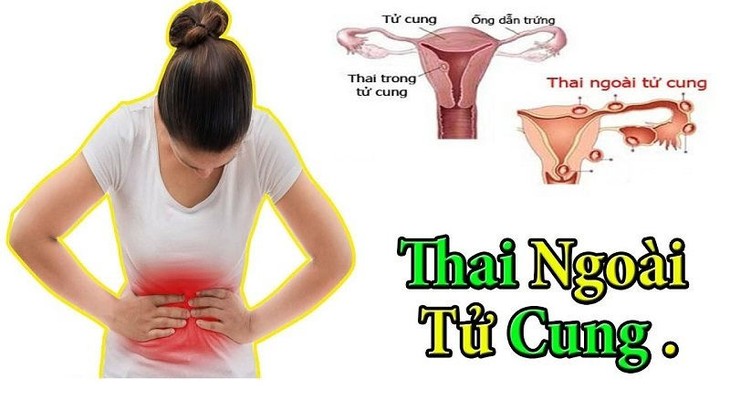 Cách phòng ngừa thai ngoài tử cung ảnh 1 thai-ngoai-tu-cung.jpg