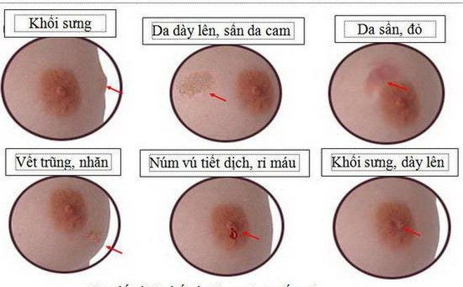 U vú tái phát, di căn vì mổ không đúng chuyên khoa. ung-thu-vu-1(1).jpg