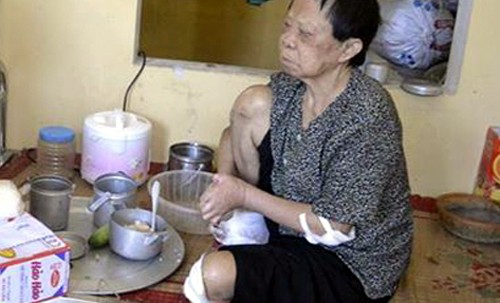 TT Da liễu Hà Đông ăn bớt thuốc của bệnh nhân phong 