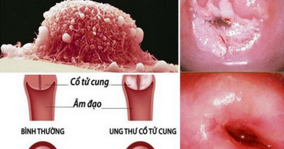 Yêu từ năm 16 tuổi khiến cô gái mắc ung thư cổ tử cung