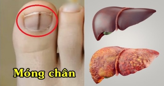 4 dấu hiệu ở bàn chân cảnh báo chức năng gan suy giảm