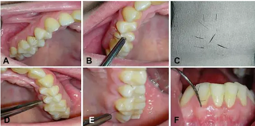 Cô gái 25 tuổi mọc lông ở nướu răng, bác sĩ sửng sốt