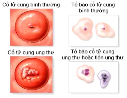 Cách dễ dàng phát hiện ung thư cổ tử cung