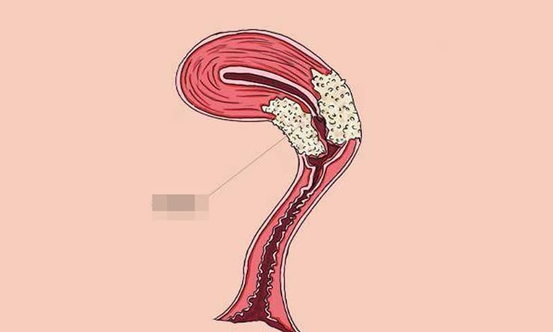 Phụ nữ khi đi vệ sinh hãy để ý nếu có 3 dấu hiệu này 