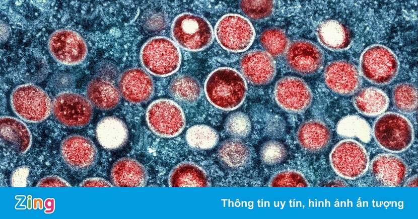 Người nhiễm virus Mpox gây bệnh đậu mùa khỉ nên đi xét nghiệm HIV