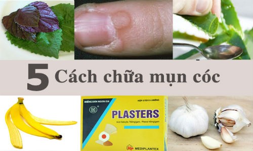 5 cách tốt nhất chữa mụn cóc tại nhà