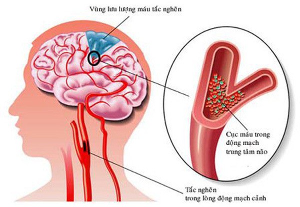 Nắng nóng 41 độ, cảnh báo 7 dấu hiệu sớm của đột quỵ, giúp bạn thoát chết trong gang tấc