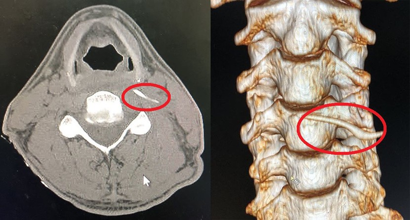 Uống "nước thần" chữa hóc xương, người đàn ông nhập viện khẩn cấp