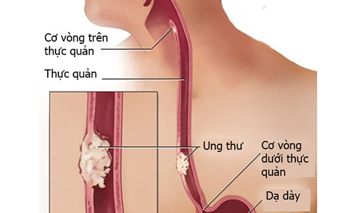 Dấu hiệu dễ thấy của ung thư thực quản