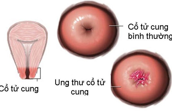 Cách tự phát hiện ung thư cổ tử cung tại nhà