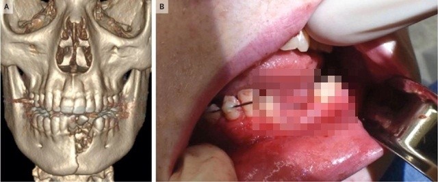 Cậu bé 17 tuổi gãy đôi xương hàm vì thuốc lá điện tử phát nổ