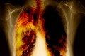 Phân biệt dấu hiệu ung thư phổi và viêm họng thông thường