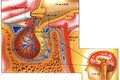 Những điều cần biết về cách điều trị ung thư não