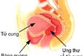 Các cách chăm sóc bệnh nhân ung thư cổ tử cung