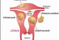 Phân biệt u xơ và ung thư cổ tử cung