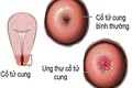 Các loại ung thư cổ tử cung phổ biến