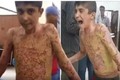 Sát thương kinh hoàng của vũ khí phốt pho Thổ Nhĩ Kỳ 