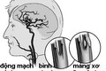 Phân biệt bệnh hẹp động mạch cảnh