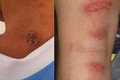 Phân biệt viêm da và nhiễm ký sinh trùng