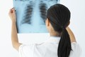 Lao màng phổi kiêng món gì?