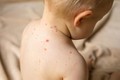 Ca mắc thủy đậu ở trẻ tăng cao: Những biến chứng nguy hiểm