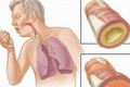 Biểu hiện lạ nguy hiểm trong chữa ung thư phổi