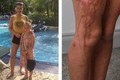 Bé 9 tuổi bị bỏng nặng như tạt axit vì dùng kem chống nắng