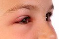 Hình ảnh đau mắt đỏ ở trẻ em: ủ đến phát bệnh