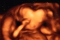 Kỳ lạ thai nhi có đầu hình trái tim