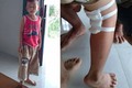 Những trường hợp mổ nhầm chân ở Việt Nam