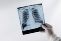 Chụp X-quang phát hiện nhiều người trẻ phổi trắng xóa, nguyên nhân vì sao?