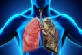 Những dấu hiệu trên chân có thể “dự đoán” ung thư phổi
