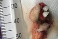 Phát hiện khối u quái dị mọc răng trong bụng bé gái 12 tuổi ở Quảng Ninh