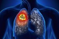 Những dấu hiệu sớm cảnh báo bệnh ung thư phổi