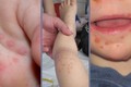 Virus tay chân miệng từng khiến 164 người tử vong nguy hiểm thế nào? 