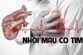 Loạt dấu hiệu nhận biết nhanh của nhồi máu cơ tim